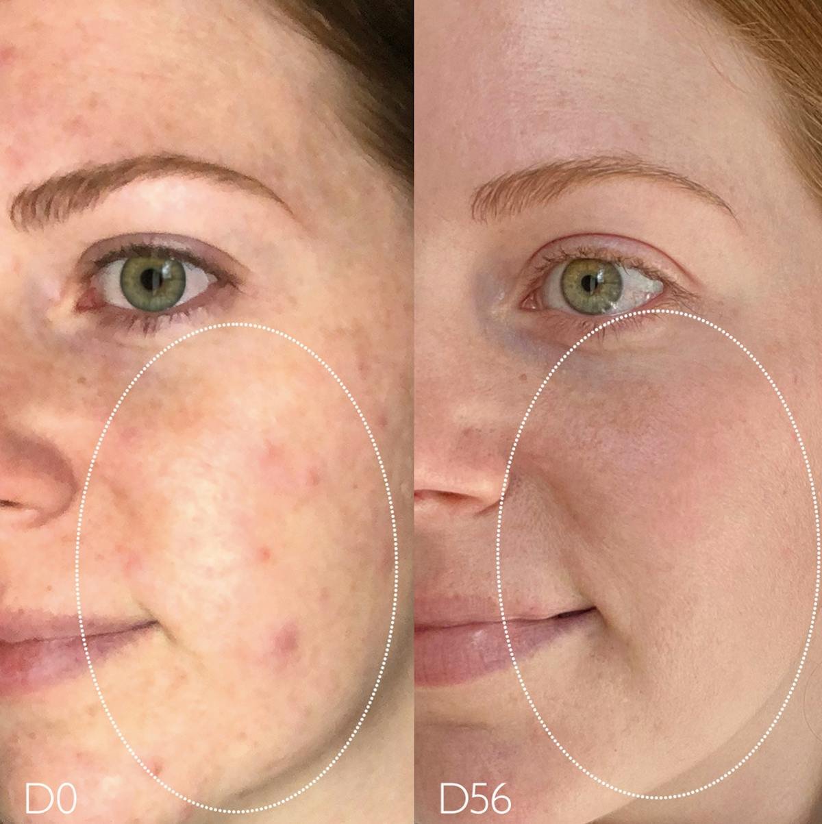 What Does Salicylic Acid Toner Do?