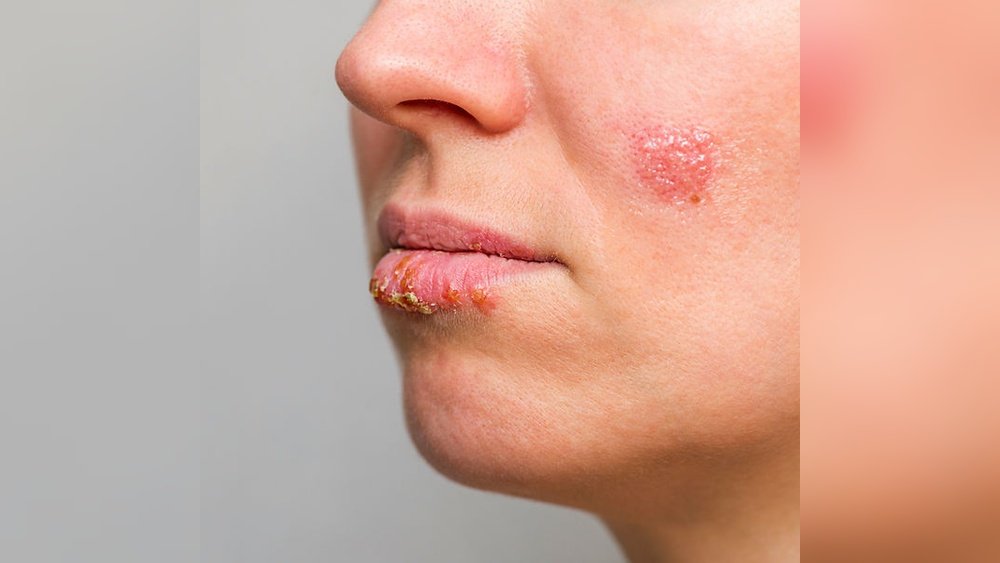 Can You Get a Cold Sore on Your Cheek