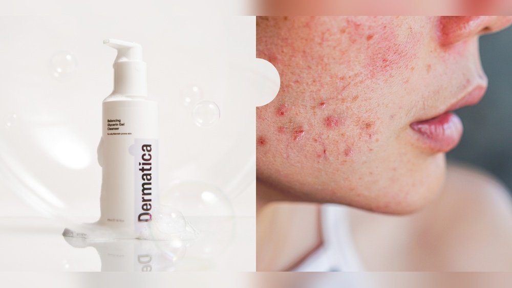 How to Get Rid of Cheek Acne Overnight