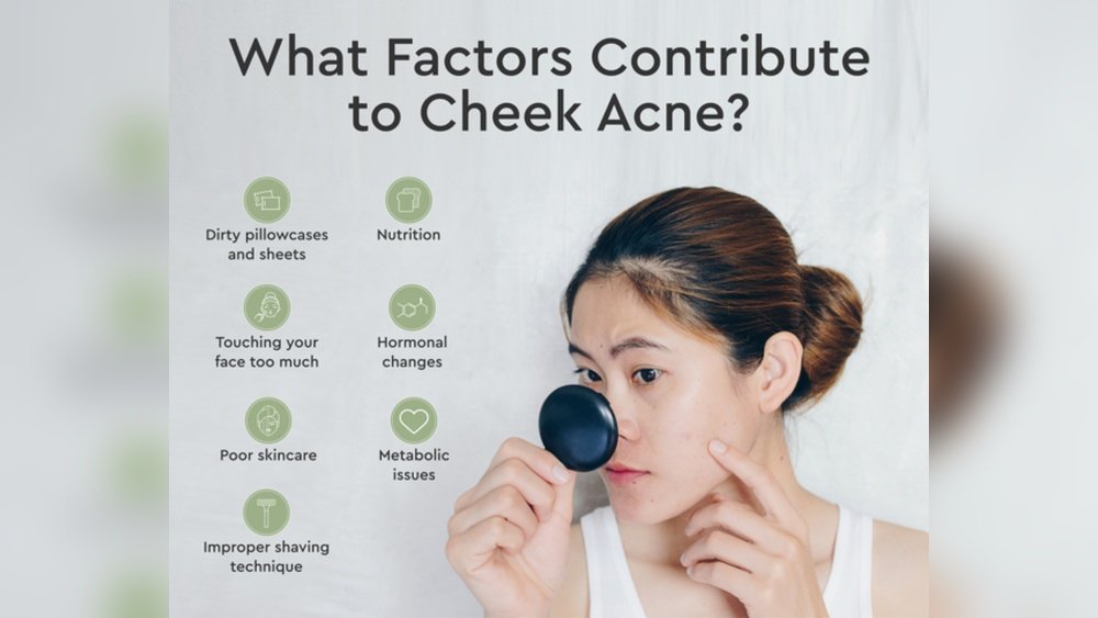 How to Get Rid of Cheek Acne