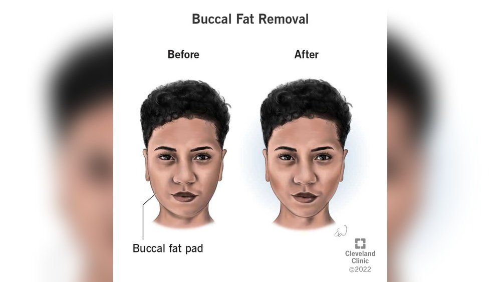 How to Lose Cheek Fat