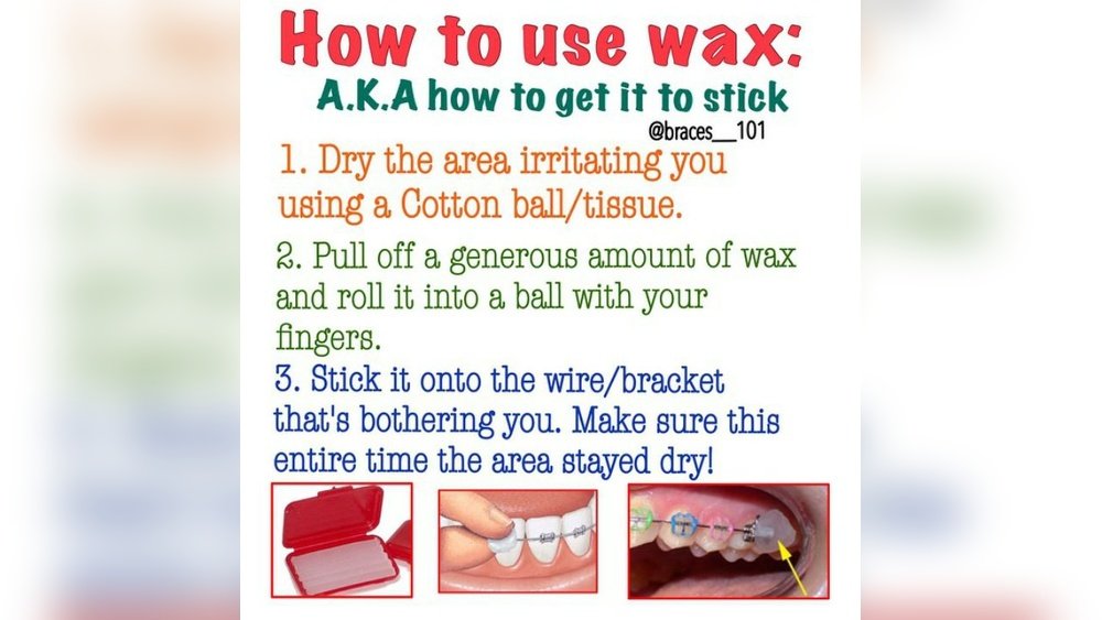 How to Stop Braces Rubbing on Cheek Without Wax