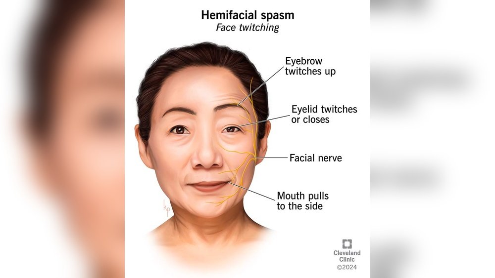 How to Stop Left Cheek Twitching