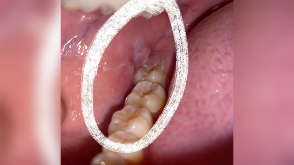 How to Treat Swollen Inside Cheek