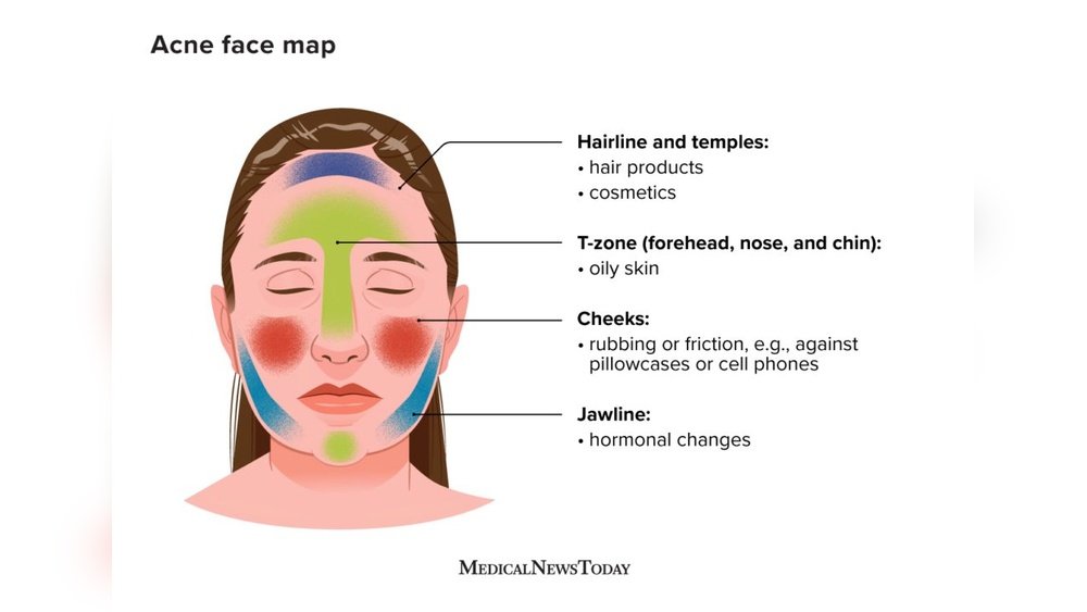 What Causes Cheek Acne
