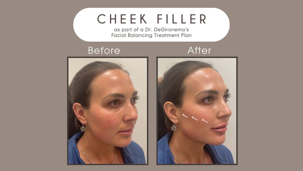 What Does Cheek Filler Do