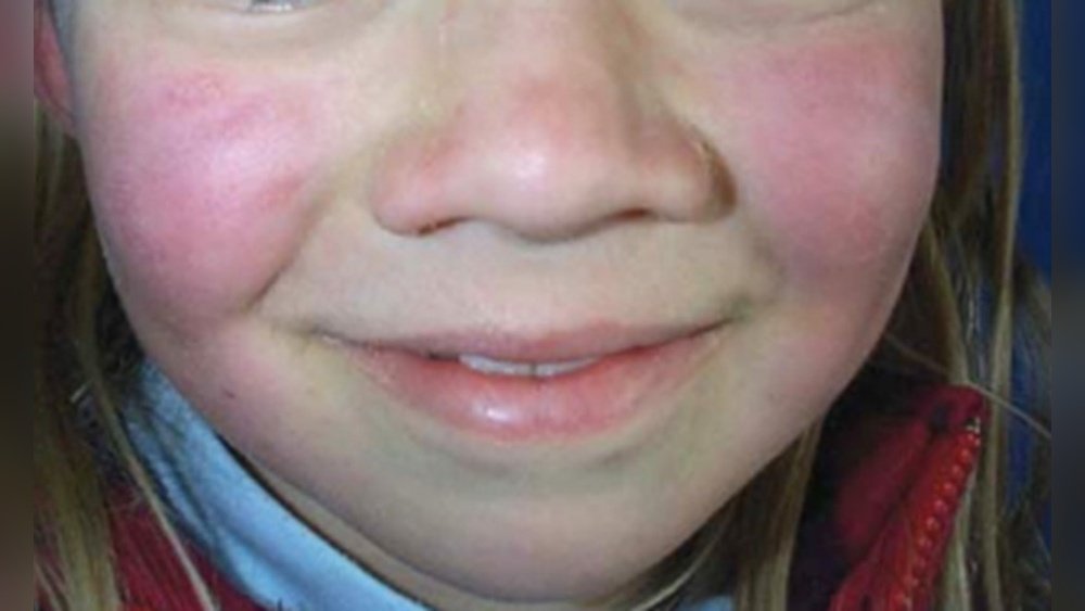 What is Slapped Cheek Syndrome