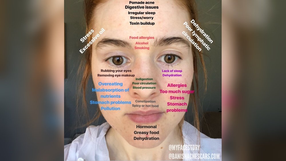 Why am I Breaking Out on My Cheek